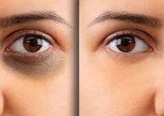 डार्क सर्कल से छुटकारा पाने के प्रभावी घरेलू उपाय